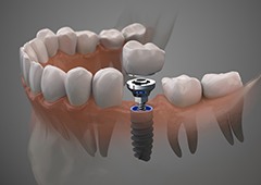 Example of dental implant in Waverly